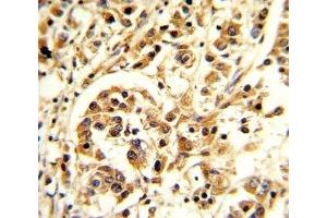 IHC analysis of FFPE human breast carcinoma stained with IL-12 antibody (IL12 antibody  (AA 168-195))