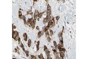 ABIN6266575 at 1/200 staining human breast carcinoma tissue sections by IHC-P. (Cytokeratin 7 antibody  (C-Term))