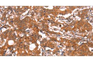 Immunohistochemistry of paraffin-embedded Human gastric cancer using FUT1 Polyclonal Antibody at dilution of 1:30 (FUT1 antibody)