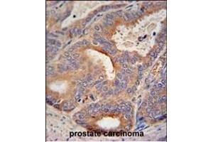 GLB1L2 antibody (C-term) (ABIN654822 and ABIN2844495) immunohistochemistry analysis in formalin fixed and paraffin embedded human prostate carcinoma followed by peroxidase conjugation of the secondary antibody and DAB staining. (GLB1L2 antibody  (C-Term))