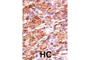 Formalin-fixed and paraffin-embedded human cancer tissue reacted with the primary antibody, which was peroxidase-conjugated to the secondary antibody, followed by AEC staining. (Retinoblastoma 1 antibody  (pSer811))