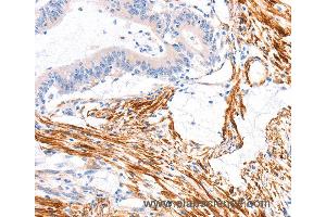 Immunohistochemistry of Human colon cancer using ARAP1 Polyclonal Antibody at dilution of 1:80