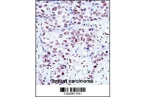 NCK1 Antibody immunohistochemistry analysis in formalin fixed and paraffin embedded human breast carcinoma followed by peroxidase conjugation of the secondary antibody and DAB staining. (NCK1 antibody  (N-Term))