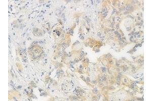 ABIN6256377 and ABIN6267565 at 1/100 staining human tongue carcinoma by IHC-P.