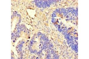 Immunohistochemistry of paraffin-embedded human ovarian cancer using ABIN7144980 at dilution of 1:100 (DDX19A antibody  (AA 1-478))
