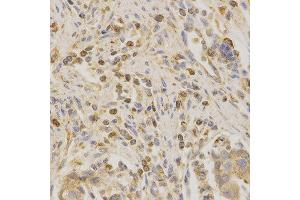 Immunohistochemistry of paraffin-embedded human stomach cancer using Bak1 antibody at dilution of 1:200 (x400 lens).