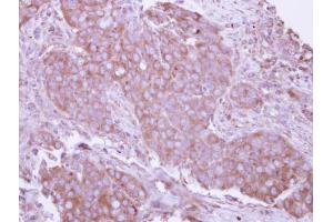 IHC-P Image Immunohistochemical analysis of paraffin-embedded human breast cancer, using CD27, antibody at 1:250 dilution. (CD27 antibody)