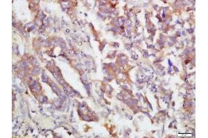 Formalin-fixed and paraffin embedded human lung carcinoma labeled with Rabbit Anti-MKK3(Ser218)/MKK6(Ser207) Polyclonal Antibody, Unconjugated  at 1:200 followed by conjugation to the secondary antibody and DAB staining (MAP2K3 antibody  (pSer207))