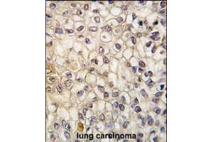 Formalin-fixed and paraffin-embedded human lung carcinoma tissue reacted with CYP2F1 antibody , which was peroxidase-conjugated to the secondary antibody, followed by DAB staining.