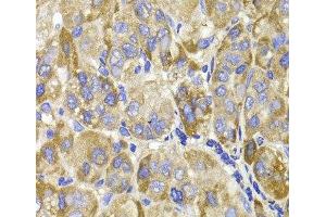 Immunohistochemistry of paraffin-embedded Human liver cancer using MAGED1 Polyclonal Antibody at dilution of 1:100 (40x lens). (MAGED1 antibody)