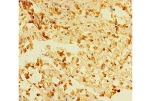 Immunohistochemistry of paraffin-embedded human melanoma using ABIN7166648 at dilution of 1:100 (ACOT6 antibody  (AA 1-207))