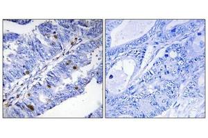 Immunohistochemical analysis of paraffin-embedded human colon carcinoma tissue using Nuclear Receptor NR4A1 (Phospho-Ser351) antibody (left)or the same antibody preincubated with blocking peptide (right). (NR4A1 antibody  (pSer351))