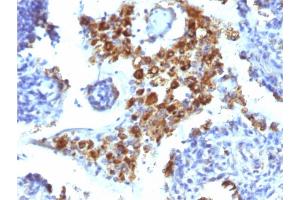 Formalin-fixed, paraffin-embedded human Lung Adenocarcinoma stained with Napsin A Mouse Monoclonal Antibody (NAPSA/1238). (NAPSA antibody  (AA 189-299))