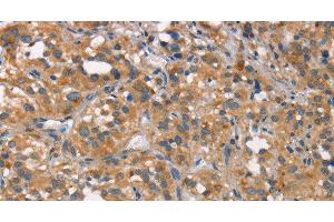 Immunohistochemistry of paraffin-embedded Human thyroid cancer tissue using CEACAM6 Polyclonal Antibody at dilution 1:50 (CEACAM6 antibody)