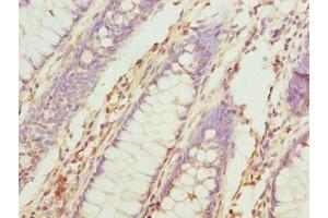 Immunohistochemistry of paraffin-embedded human colon cancer using ABIN7173695 at dilution of 1:100 (TUBb6 antibody  (AA 1-446))