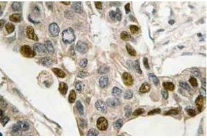 Immunohistochemistry (IHC) analyzes of c-Myb antibody in paraffin-embedded human breast carcinoma tissue. (MYB antibody)