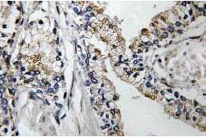 Immunohistochemistry (IHC) analyzes of VDR antibody in paraffin-embedded human prostate carcinoma tissue. (Claudin 7 antibody)