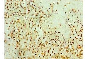 Immunohistochemistry of paraffin-embedded human breast cancer using ABIN7165774 at dilution of 1:100
