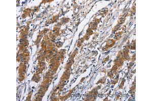 Immunohistochemistry of Human thyroid cancer using NCAPD3 Polyclonal Antibody at dilution of 1:50