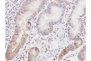 IHC-P Image Immunohistochemical analysis of paraffin-embedded human gastric cancer, using DLD, antibody at 1:100 dilution.