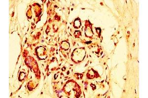 IHC image of ABIN7162334 diluted at 1:300 and staining in paraffin-embedded human breast cancer performed on a Leica BondTM system. (OTUD5 antibody  (AA 51-183))