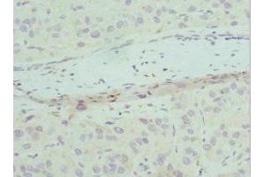 Immunohistochemistry of paraffin-embedded human liver cancer using ABIN7147523 at dilution of 1:100 (CHMP2B antibody  (AA 1-213))