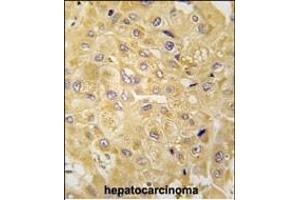 Formalin-fixed and paraffin-embedded human hepatocarcinoma tissue reacted with ILK1/ILK2 Antibody (N-term) (ABIN391993 and ABIN2841781) , which was peroxidase-conjugated to the secondary antibody, followed by DAB staining. (ILK antibody  (N-Term))