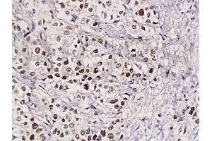 Formalin-fixed and paraffin embedded human gastric carcinoma with Anti-Pokemon Polyclonal Antibody, Unconjugated (ABIN729448) at 1:200, followed by conjugation to the secondary antibody and DAB staining (ZBTB7A antibody  (AA 151-250))