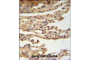 FKBPL Antibody IHC analysis in formalin fixed and paraffin embedded lung carcinoma followed by peroxidase conjugation of the secondary antibody and DAB staining. (FKBPL antibody  (C-Term))