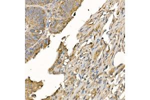 Immunohistochemistry of paraffin-embedded human colon carcinoma using GSDMD (Full Length+N terminal) Rabbit pAb  at dilution of 1:100 (40x lens). (GSDMD antibody)