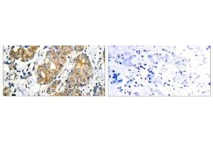 Immunohistochemical analysis of paraffin- embedded human breast carcinoma tissue using GSK3α (Ab-21) antibody (E021007). (GSK3 alpha antibody)