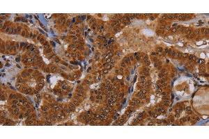 Immunohistochemistry of paraffin-embedded Human thyroid cancer tissue using WDR83 Polyclonal Antibody at dilution 1:60 (MORG1 antibody)