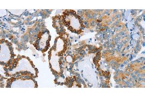 Immunohistochemistry of paraffin-embedded Human thyroid cancer tissue using AIP Polyclonal Antibody at dilution 1:80 (AIP antibody)