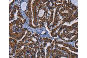 Immunohistochemistry of Human colon cancer using ADRBK2 Polyclonal Antibody at dilution of 1:40