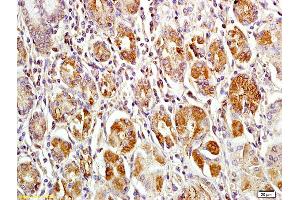Formalin-fixed and paraffin embedded human gastric carcinoma labeled with Anti-MACC1 Polyclonal Antibody, Unconjugated (ABIN706526) at 1:200 followed by conjugation to the secondary antibody and DAB staining (MACC1 antibody  (AA 761-852))