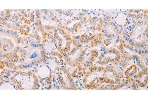 Immunohistochemistry of paraffin-embedded Human thyroid cancer tissue using MAP3K12 Polyclonal Antibody at dilution 1:30