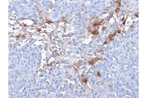 Formalin-fixed, paraffin-embedded human melanoma stained with CD146 antibody (MUC18/1130)