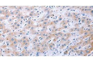 Immunohistochemistry of paraffin-embedded Human liver cancer tissue using FGF4 Polyclonal Antibody at dilution 1:40 (FGF4 antibody)
