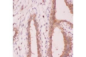Anti-NFkB p100 Picoband antibody,  IHC(P): Human Mammary Cancer Tissue (NFKB2 antibody  (AA 1-340))