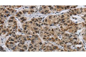 Immunohistochemistry of paraffin-embedded Human liver cancer using HNRNP L Polyclonal Antibody at dilution of 1:40 (HNRNPL antibody)