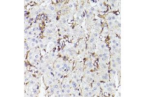 Immunohistochemistry of paraffin-embedded human liver cancer using TLR8 Rabbit pAb (ABIN3022014, ABIN3022015, ABIN3022016, ABIN1513616 and ABIN6218568) at dilution of 1:150 (40x lens). (TLR8 antibody  (AA 849-1041))