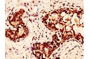 IHC image of nphHU diluted at 1:50 and staining in paraffin-embedded human breast cancer performed on a Leica BondTM system. (H2AFX antibody)