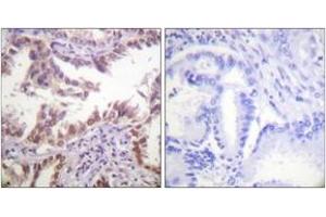 Immunohistochemistry analysis of paraffin-embedded human lung carcinoma tissue, using Histone H3 (Ab-14) Antibody.