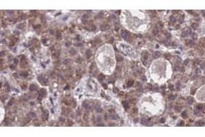 ABIN6273876 at 1/100 staining Human liver cancer tissue by IHC-P. (FFAR2 antibody  (C-Term))