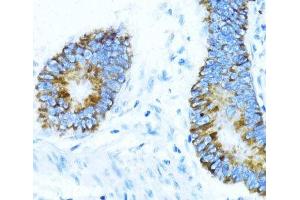 Immunohistochemistry of paraffin-embedded Human colon carcinoma using NOX1 Polyclonal Antibody at dilution of 1:100 (40x lens). (NOX1 antibody)