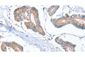 Immunohistochemistry of paraffin-embedded Human colon cancer tissue using MTMR7 Polyclonal Antibody at dilution 1:40 (MTMR7 antibody)