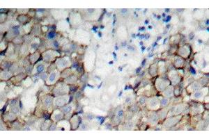 Immunohistochemistry of paraffin-embedded Human breast carcinoma using Phospho-IGF1R(Y1161) Polyclonal Antibody (IGF1R antibody  (pTyr1161))