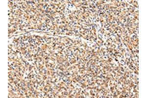 The image on the left is immunohistochemistry of paraffin-embedded Human prostate cancer tissue using ABIN7189649(ADAMTS1 Antibody) at dilution 1/35, on the right is treated with synthetic peptide. (ADAMTS1 antibody)