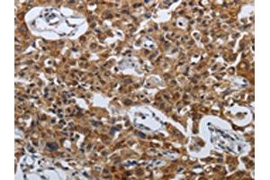 The image on the left is immunohistochemistry of paraffin-embedded Human lung cancer tissue using ABIN7192614(SPAG4 Antibody) at dilution 1/50, on the right is treated with synthetic peptide. (SPAG4 antibody)