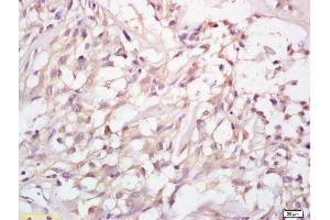 Formalin-fixed and paraffin embedded human cervical carcinoma labeled with Anti-MMP-23 Polyclonal Antibody, Unconjugated (ABIN759176) at 1:200 followed by conjugation to the secondary antibody (Matrix Metallopeptidase 23 (MMP23) (AA 281-380) antibody)